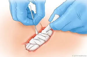 Packing Gauze 2.5cm x 1m